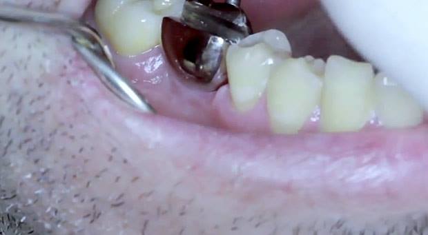implante-dentário-abridor-de-latas-1