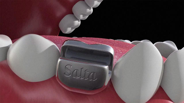 implante-dentário-abridor-de-latas-2